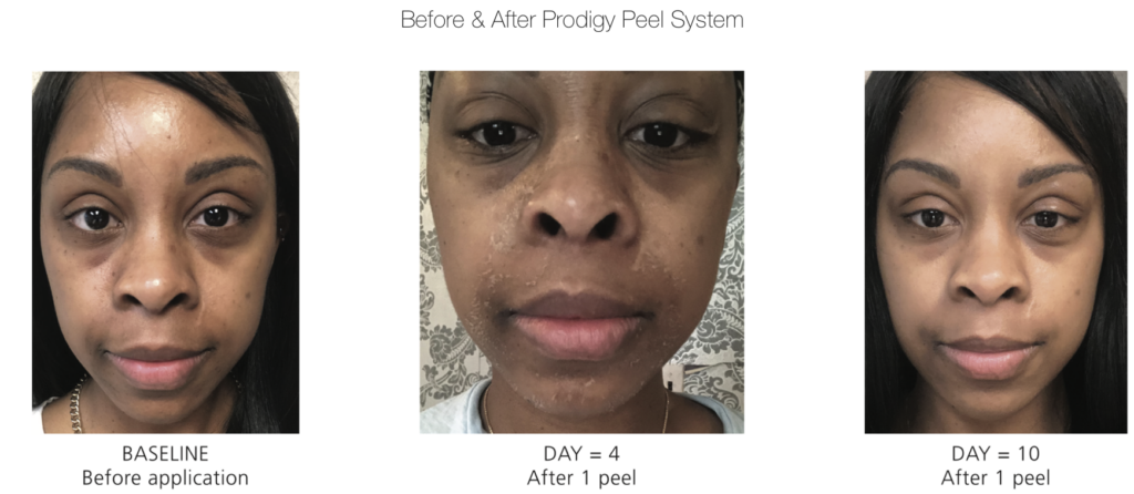 Prodigy Peel System iS Clinical